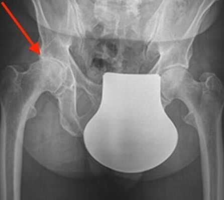 Röntgenbild Arthrose der rechten Hüfte (Coxarthrose)