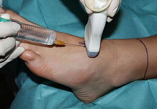 Teilnarkose per Ultraschall für eine Fuß- oder Sprunggelenk-OP