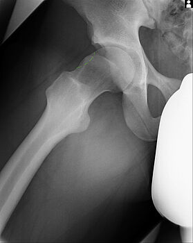 Das Röntgenbild zeigt eine unzureichende Taillierung des Schenkelhalses bei einem CAM-Impingement