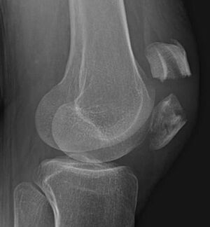 Röntgenbild einer Patellafraktur