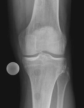 Röntgenbild eines gesunden Kniegelenks