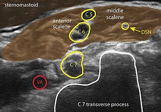 Ultraschallbild zur Vorbereitung der Narkose bei einer Schulter OP 