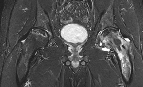 Magnetresonanztomographie (MRT) - Bild einer beidseitigen Hüftkopfnekrose (HKN)