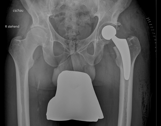 Postoperatives Röntgenbild nach Hüft-Tep Versorgung mit Kurzschaftimplantat beim jungen Patienten