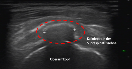 Ultraschall der Schulter mit Kalkdepot in der Supraspinatussehne