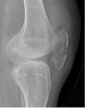 Röntgenbild einer Patellafraktur