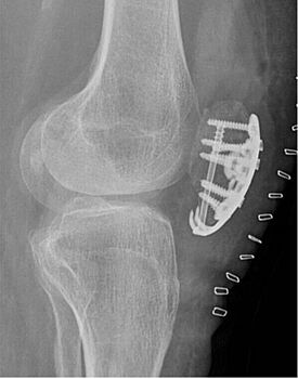 Plattenosteosynthese mit winkelstabilen Schrauben bei Patellafraktur und reduzierter Knochenqualität (Osteopenie/ Osteoporose)