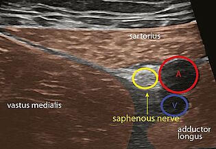 Ultraschallbild zur Vorbereitung der Narkose bei einer Knie OP 