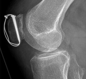 „Zuggurtungs-Osteosynthese“ mit durchbohrten Schrauben zur operativen Versorgung einer gebrochenen Kniescheibe