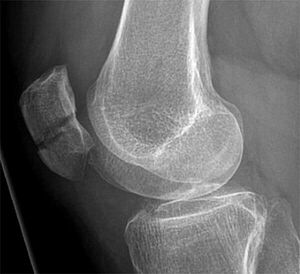 Röntgenbild: Kniescheibe gebrochen