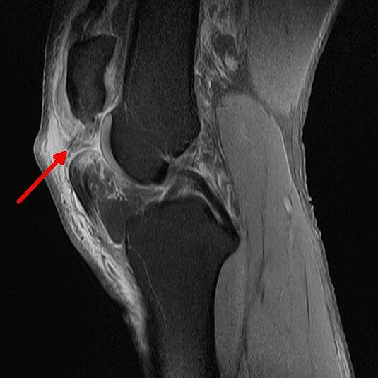 Röntgenbild Riss Patellasehne Kniescheibe