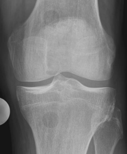 Röntgenbild eines gesunden Kniegelenks mit ausreichendem Knorpelgewebe innerhalb des Gelenkspalts.