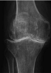 Röntgenbild eines Knies mit fortgeschrittener Arthrose