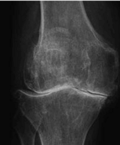 Röntgenbild einer fort. Arthrose des medialen    und lateralen Kniegelenkkompartimentes mit vollständigem Knorpelaufbrauch.