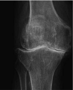 Röntgenbild eines Knies mit fortgeschrittener Arthrose