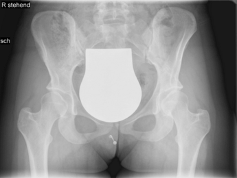 Röntgenbild des Beckens bei einer beidseitigen Hüftdysplasie