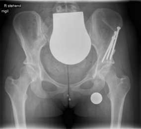 Röntgenbild des Beckens nach einer Pfannenkorrektur