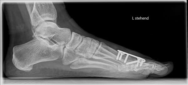 Seitliches Röntgenbild des Fußes nach Großzehengrundgelenks Arthrodese bei Hallux rigidus