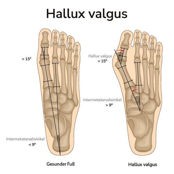 Winkelveränderung im Bereich des Großzehengelenks bei einem Hallux valgus im Vergleich zu einem gesunden Fuß.
