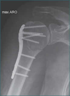 Stabilisierung eines Oberarmkopfbruches mit Platte und Schrauben