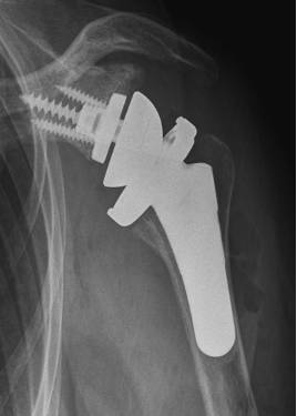 Nach Implantation einer zementfreien inver sen Schulterprothese (Quelle: Comprehensive Micro, Fa. ZimmerBiomet, Germany)