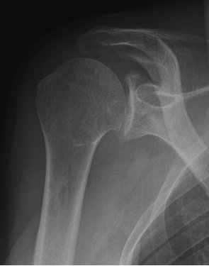 Röntgenbild einer Arthrose des Schultergelenks (Omarthrose) mit aufgehobenem Gelenkspalt und knöchernen Anbauten
