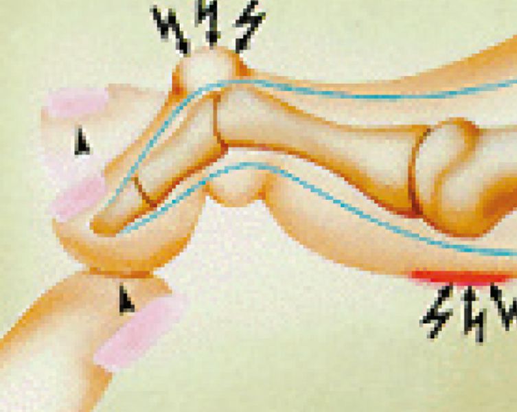 Druckprobleme bei Hammerzehe (Quelle: Gesellschaft für Fußchirurgie)