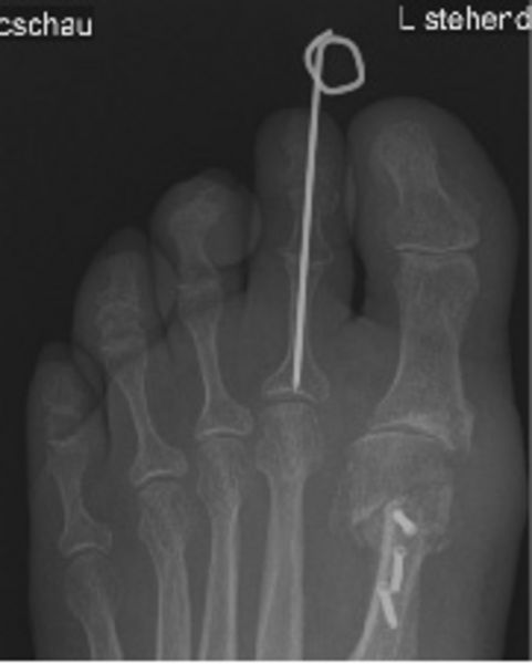 Hohmann anterior-posterior Projektion Post-OP