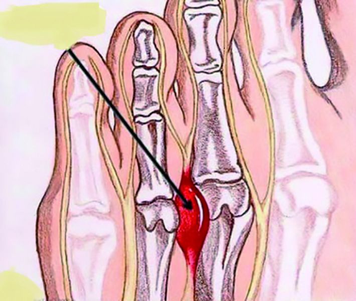 Morton Neurinom
