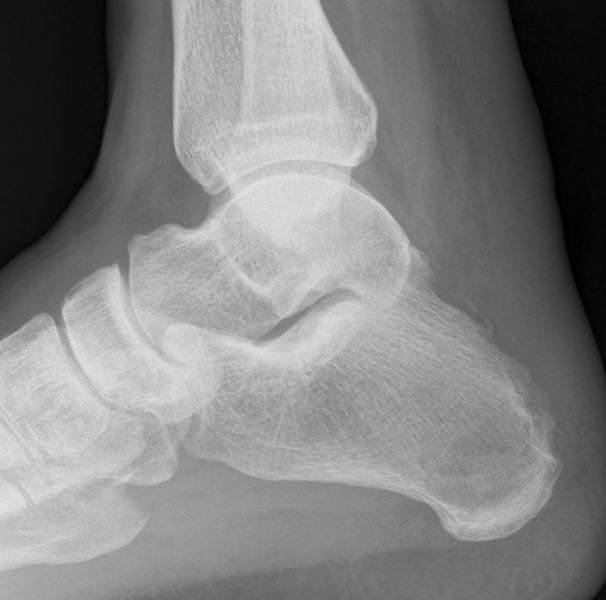 Achillo Speed Post-OP
