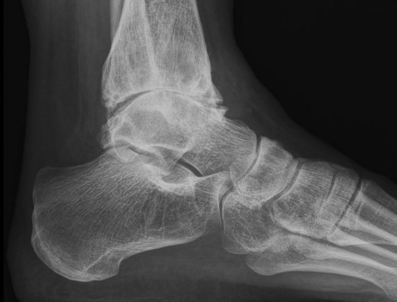 Arthrose OSG
