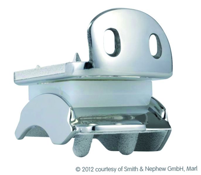 Hintegra OSG (Quelle: Smith & Nephew GmbH)
