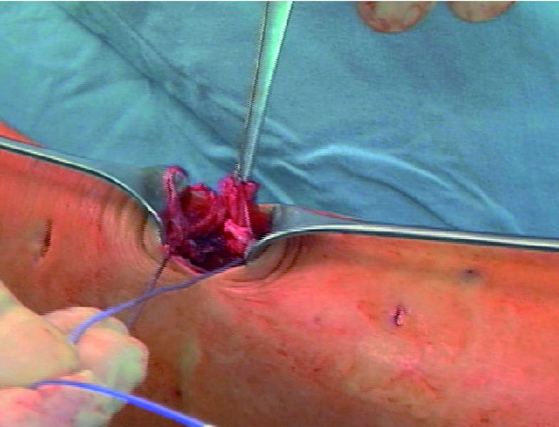Minimalinvasive Achillessehnennaht