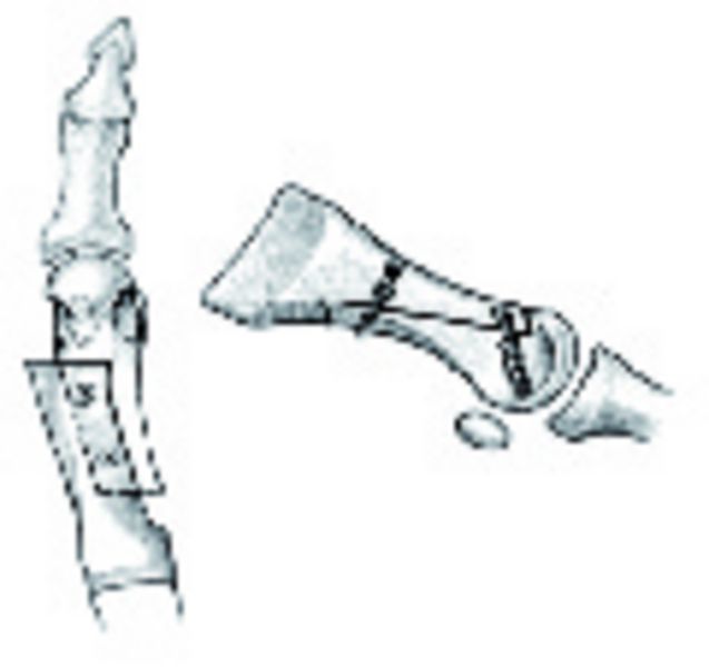 Großzehenkorrektur nach Scarf-Osteotomie (Quelle: Gesellschaft für Fußchirurgie)