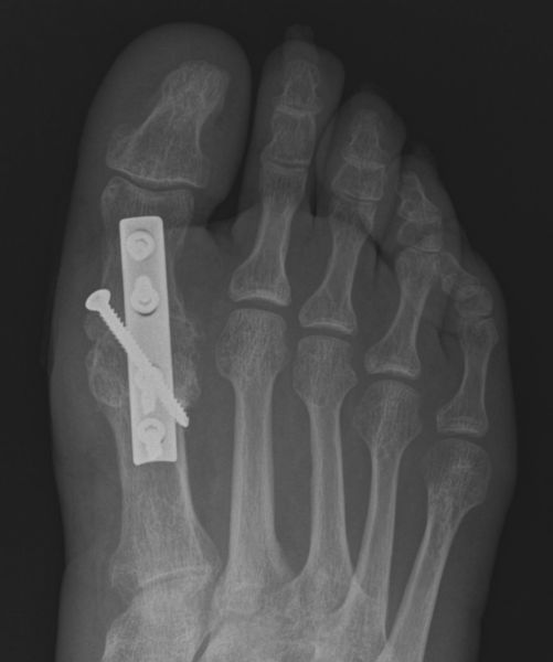 Hallux rigidus OP ARCUS Kliniken Pforzheim