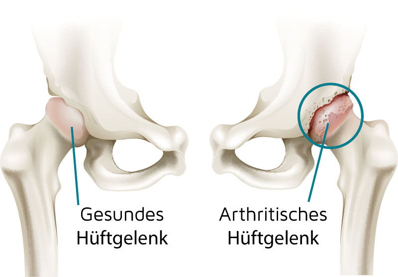 Unterschied gesundes Hüftgelenk und arthrotisches Hüftgelenk