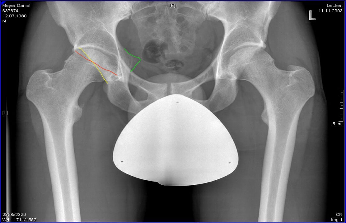 Impingement der Hüfte (FAI) - ARCUS Kliniken