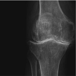 Röntgenbild: Fortgeschrittene Arthrose des medialen und lateralen Kniegelenkkompartimentes mit vollständigem Knorpelaufbrauch.