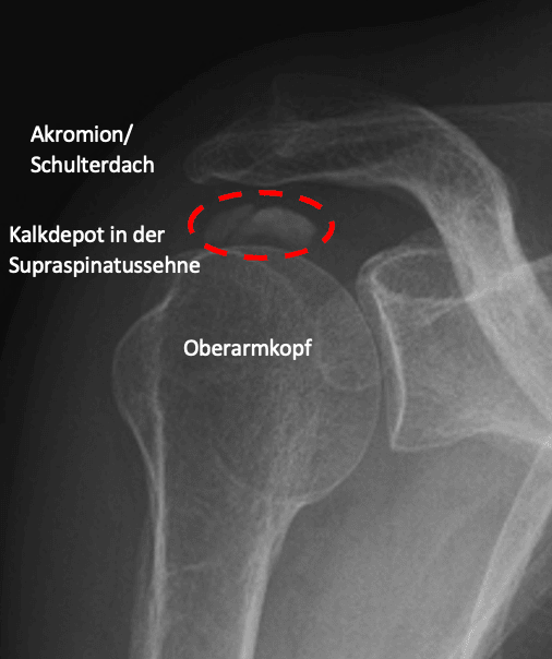 Röntgenbild mit Kalkdepot in der Supraspinatussehne