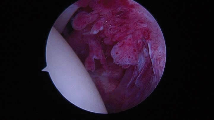 Arthroskopisches Bild einer Kapsulitis (Entzündung der Gelenkinnenhaut bei Frozen Shoulder Erkrankung)