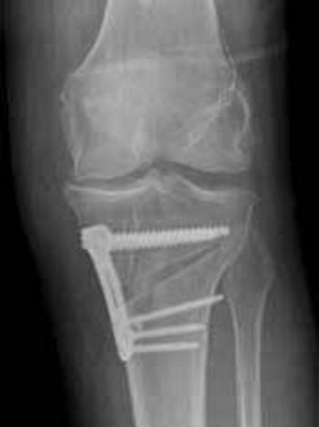 Winkelstabilaufklappende Umstellung einer O-Bein-Fehlstellung am Unterschenkel