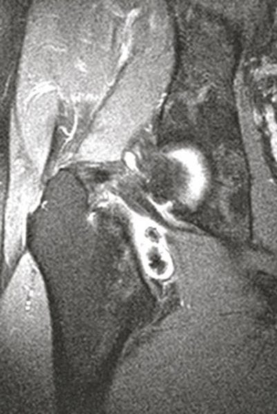 Kernspin (MRT): zwei große Gelenkkörper auf der Innenseite des Schenkelhalses