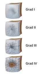 Schematische Darstellung der Arthrose Schweregrade 