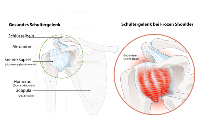 Darstellung eines gesunden Schultergelenks (links) und eines Schultergelenks bei einer Frozen Shoulder Erkrankung (rechts), (Quelle: Axel Kock-stock.adobe.com)