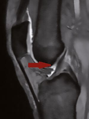 Vorderes Kreuzband im MRT des Kniegelenks
